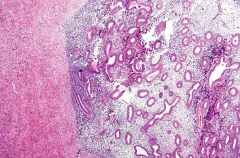 Imagen: Una fotomicrografía mostrando la endometriosis del ovario (Fotografía cortesía de Nephron).