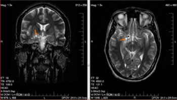 Imagen: Dos imágenes de RM de un glioma cerebral de bajo grado en un varón de 28 años (Fotografía cortesía de Wikimedia Commons).
