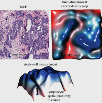 Imagen: Un lámina de histología coloreada con hematoxilina y eosina (H&E) y el mapa correspondiente de la densidad tridimensional del cáncer, lo cual facilita la medición de la proximidad espacial al cáncer para cada uno de los linfocitos individuales en la imagen (Fotografía cortesía del Instituto para la Investigación del Cáncer).