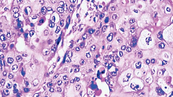 Imagen: Una histopatología de un cáncer de mama triple negativo (Fotografía cortesía de Joe Segen).