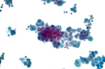 Imagen: Una microfotografía de una muestra de citopatología de líquido pleural mostrando un mesotelioma (Fotografía cortesía de Wikimedia Commons).