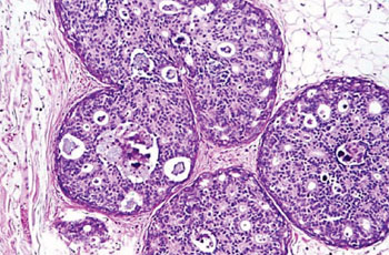Imagen: Fotomicrografía de un carcinoma ductal de mama in situ que muestra varios ductos que se llenan con células de cáncer (Fotografía cortesía de Breastpath).