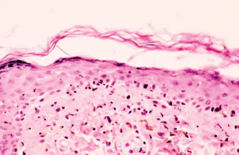 Imagen: Histología de la inflamación crónica de la dermis superior con infiltrado linfocítico perivascular y linfocitos epidérmicos de un pacientes con enfermedad de injerto versus huésped. (Fotografía cortesía de la Dra. Amy Lynn).