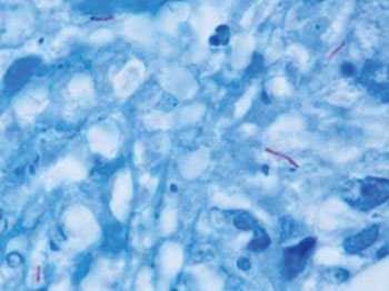Imagen: Mycobacterium tuberculosis (de color morado) en una muestra de tejido (azul) (Fotografía cortesía de los CDC).