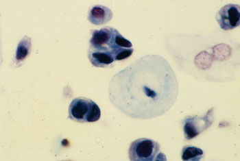 Image: Células de carcinoma urotelial de alto potencial maligno en una muestra de orina (Fotografía cortesía de Michael Gordon, PhD).