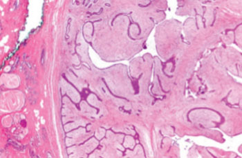 Imagen: Una microfotografía de un tumor filoides (derecha de la imagen) con las hendiduras largas características y el estroma celular mixoide. También se observan tejido normal de mama y con cambio fibroquístico (izquierda de la imagen) (Fotografía cortesía de Wikimedia Commons).
