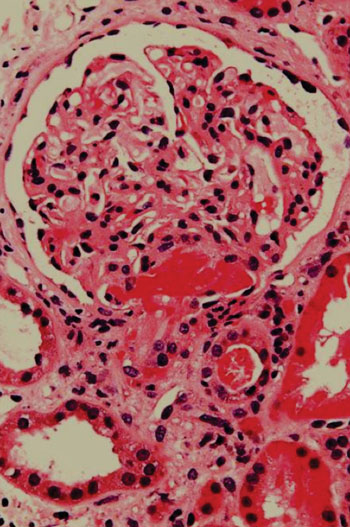 Imagen: Una histología de una biopsia renal de un paciente con púrpura trombótica trobocitopénica (TPP), mostrando una microangiopatía trombótica aguda (Fotografía cortesía de Nephron).