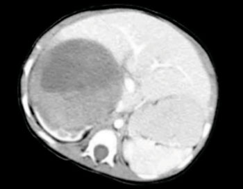 Imagen: Una tomografía computarizada de un tumor de Wilms, de 11 centímetros,  en el riñón derecho, en un paciente de 13 meses de edad (Foto cortesía de Wikimedia Commons).