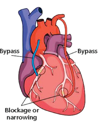 Imagen: Injerto de derivación de las arterias coronarias (Fotografía cortesía del Instituto del Corazón de Intermountain).