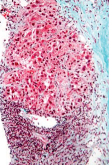 Imagen: Micrografía de un carcinoma hepatocelular tomada de una biopsia hepática y coloreada con la coloración tricrómica (Fotografía cortesía de Wikimedia Commons).