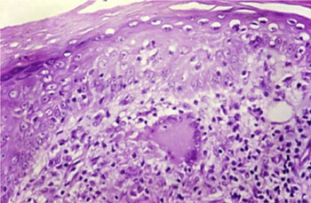 Imagen: Una histopatología de la lepra tuberculoide en un corte de piel (Fotografía cortesía del Dr. DS Ridley, Wellcome Images).