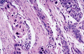 Imagen: Una histopatología de carcinoma de esófago mostrando nidos infiltrantes de células neoplásicas (Fotografía cortesía del Dr. Elliot Weisenberg, MD).