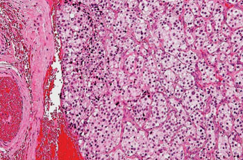 Imagen: Una histopatología de un paraganglioma, un tumor del cuerpo carotídeo (Fotografía cortesía de Nephron).