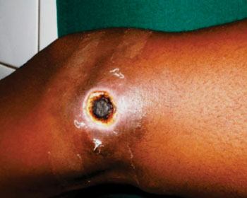 Imagen B: Una úlcera Buruli en la pierna de un paciente en Ghana (Fotografía cortesía del Dr. K. Asiedu).