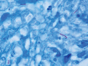 Imagen: Mycobacterium tuberculosis (de color púrpura) en una muestra de tejido (azul) (Fotografía cortesía del CDC).