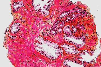Imagen: Un estudio histopatológico de una biopsia de próstata mostrando las glándulas prostáticas normales y las glándulas de un adenocarcinoma de próstata en la parte superior derecha de la imagen (Fotografía cortesía de Nephron).