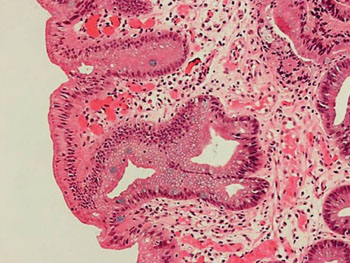 Imagen: Una histopatología del esófago de Barrett; el epitelio metaplásico del esófago de Barrett se caracteriza por células caliciformes, que toman un color azul con el azul de alcián (Fotografía cortesía de Nephron).