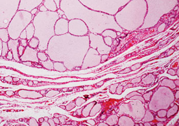 Imagen A: Una histopatología de los nódulos coloides tiroideos que muestran macrofolículos alineados por células epiteliales aplanadas de la tiroides. Los nódulos están circunscritas y no tienen una cápsula fibrosa (Fotografía cortesía de la Universidad de Siena).