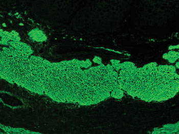 Imagen: Patrón de inmunofluorescencia con isotiocianato de fluoresceína (FITC) de anticuerpos antiendomisio, producido usando suero de un paciente con la enfermedad celíaca en esófago de mono (Fotografía cortesía de Simon Caulton).