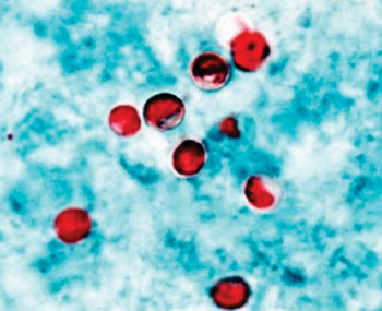 Imagen B: Ooquistes de Cryptosporidium, en una muestra de heces, visualizados con la coloración ácido-alcohol resistente (Fotografía cortesía de James Smith).