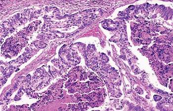 Imagen: Una histopatología de un adenocarcinoma de colon en el cual las glándulas se han agrandado y están llenas de restos necróticos (Fotografía cortesía del Dr. Charanjeet Singh, MD).