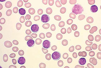 Imagen A: Un frotis de sangre de un niño con leucemia linfoide aguda (Fotografía cortesía de la Universidad Estatal de Ohio).