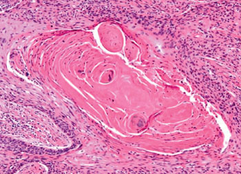 Imagen: Una histopatología de un carcinoma escamocelular de la laringe (Fotografía cortesía de Nikon).