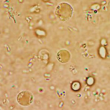 Imagen: Formas similares a quistes de Blastocystis hominis en preparaciones húmedas bajo microscopía de contraste de interferencia diferencial (DIC) (Fotografía cortesía del CDC).