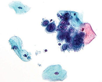 Imagen A: Una microfotografía del efecto citopático viral del virus del herpes simple (VHS) que muestra múltiples núcleos y cromatina en forma de vidrio esmerilado (Fotografía cortesía de Nephron).