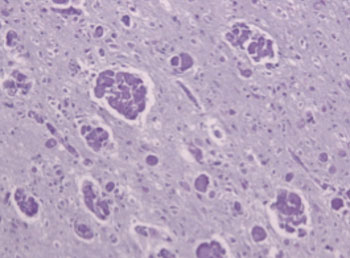 Imagen: Una leucodistrofia de células globosas: macrófagos mulinucleados (“células globoides”) y la pérdida de fibras mielinizadas en un caso de leucodistrofia de Krabbe (Fotografía cortesía de Wikimedia Commons).