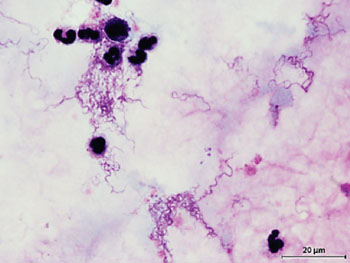 Imagen: Un frotis de sangre de gota gruesa con Giemsa muestra espiroquetas de un paciente con fiebre recurrente transmitida por piojos (Fotografía cortesía de B. Huizinga).