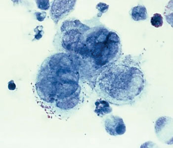 Imagen: Una microfotografía del virus del herpes simple, dentro del tejido tomado de una lesión del pene de un paciente con herpes genital (Fotografía cortesía de los CDC).