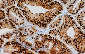 Imagen: Una coloración inmunohistoquímica de un adenocarcinoma colorrectal que muestra coloración nuclear y citoplasmática de la β-catenina (Fotografía cortesía de la Facultad de Medicina de la Universidad de Indiana).