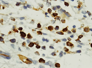 Imagen: Un prueba inmunoquímica de una biopsia de médula ósea de un paciente con leucemia mieloide aguda donde se muestran capas de células positivas para CD34; el aspirado de médula ósea correspondiente mostró sólo un 20 % de blastocitos (Fotografía cortesía del Instituto PanIndio de Ciencias Médicas).