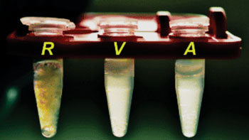 Imagen: La comparación visual de muestras de esputo humanos: (R) una muestra de esputo en bruto no-licuada; (V) una muestra de esputo licuada utilizando un mezclador vórtex; (A) una muestra de esputo licuado utilizando el dispositivo acustofluídico (Fotografía cortesía del Prof. Tony Jun Huang, PhD).