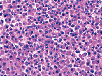 Imagen: Una microfotografía demostrando la histología típica del mieloma múltiple, con la proliferación monoclonal de las células plasmáticas (Fotografía cortesía de la Facultad de Medicina de la Universidad Estatal de Ohio).