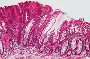 Imagen: Histopatología de un adenoma tubular (a la izquierda de la imagen), un tipo de pólipo del colon y un precursor del cáncer colorrectal (Fotografía cortesía de Nephron).