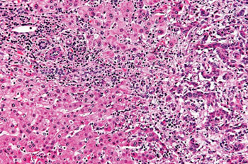 Imagen: Una histopatología de un colangiocarcinoma hiliar o tumor Klatskin (Fotografía cortesía de Nephron).