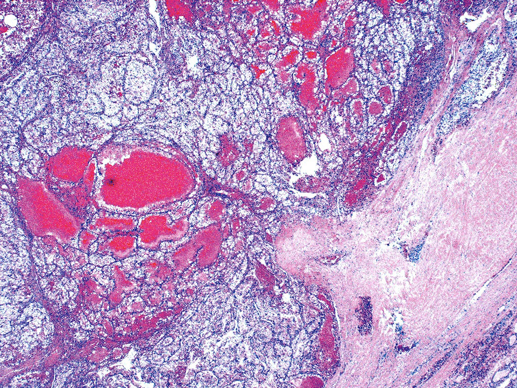 Imagen: Un estudio histopatológico de un carcinoma metastásico de células renales (Fotografía cortesía del Dr. Mark R. Wick).