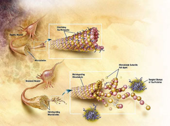 Imagen: Un diagrama de cómo los microtúbulos se desintegran con la enfermedad de Alzheimer (Fotografía cortesía del Instituto Nacional sobre el Envejecimiento de los EUA).
