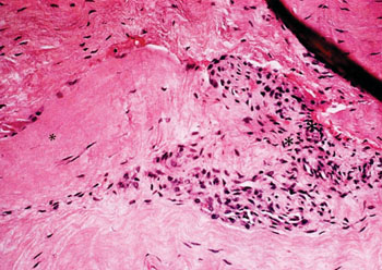 Imagen: El aspecto histológico del tejido con tendinosis muestra un patrón característico de los fibroblastos y tejido tipo granular, vascular, atípico (Fotografía cortesía del Dr. Barry S. Kraushaar, MD).