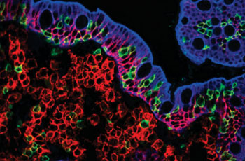 Imagen A: Una microfotografía de la mucosa del intestino delgado de un paciente con enfermedad celíaca activa (Fotografía cortesía de Ann-Christin Røberg Beitnes).