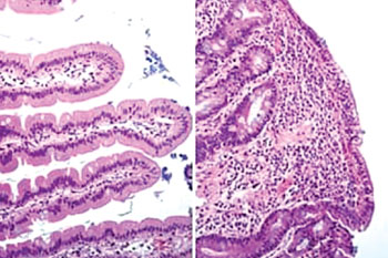 Imagen B: Una histología (a la izquierda) de un duodeno sano y de un duodeno (a la derecha) donde se muestran las vellosidades dañadas por la enfermedad celíaca (Fotografía cortesía de la Universidad de Oslo).