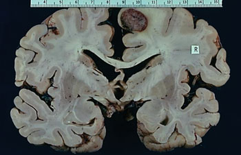 Imagen: Una patología macroscópica de metástasis cerebral, de un carcinoma papilar de tiroides (Fotografía cortesía del Dr. Nikola Kostich).