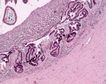 Imagen: Un estudio histopatológico de cáncer de páncreas que muestra un neoplasma mucinoso papilar, intraductal, del tipo de ducto principal (IPMN) con un enfoque en la displasia de alto grado compatible con IPMN maligno con carcinoma in situ (Fotografía cortesía del Centro Nacional del Cáncer de Singapur).