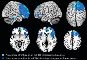 Imagen: La apolipoproteína E ε4 se asocia con efectos específicos de la enfermedad sobre la atrofia cerebral en la enfermedad de Alzheimer y la variante de la demencia conductual frontotemporal (bvFTD) (Fotografía cortesía de la Dra. Federica Agosta).