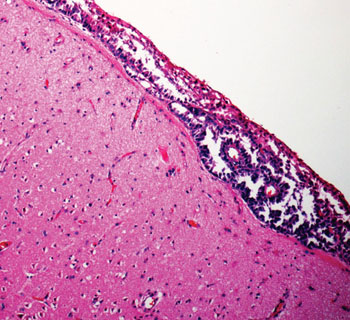 Imagen A: Una histopatología de la carcinomatosis meníngea: grupos de células tumorales en el espacio subaracnoideo en una biopsia cerebral (Fotografía cortesía del Dr. Michael J. Schneck, MD).