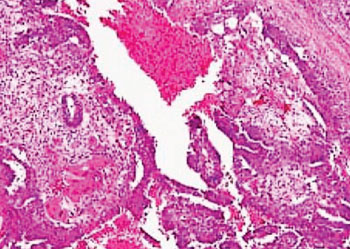 Imagen: Una histopatología de un tumor testicular de células germinales que consiste en teratoma, un carcinoma de saco vitelino embrionario y sincitiotrofoblastos (Fotografía cortesía del Centro de Cáncer Lee Moffitt).