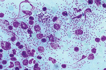 Imagen A: Frotis de un tejido de un paciente infectado con Leishmania infantum mostrando numerosos organismos protozoarios fagocitadas por los macrófagos (Fotografía cortesía del Dr. Yutaka Tsutsumi).
