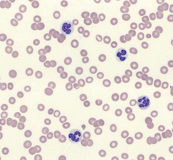Imagen: Un extendido de sangre de un paciente con citopenia idiopática de significado incierto, que muestra células anormales (Fotografía cortesía de Ciencias de la Salud en la Universidad de California de San Diego).